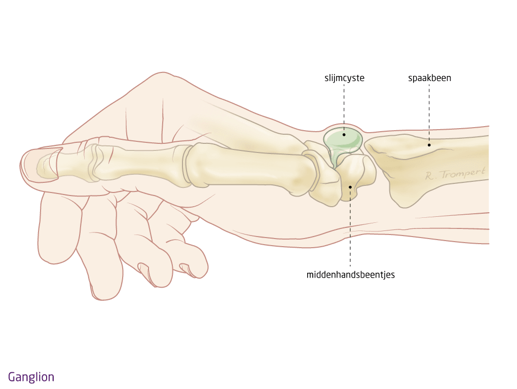 3-5-13-ganglion.png