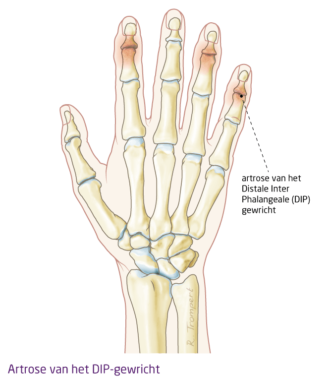 3-5-6-artrose-DIP.png