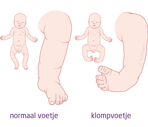 3.8.1-a-klompvoetje.png